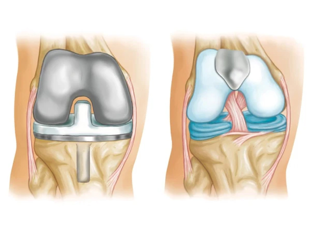 Arthroscopic/Open Patellofemoral
